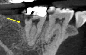 Pre-operative radiograph of mandibular second molar showing severe decay