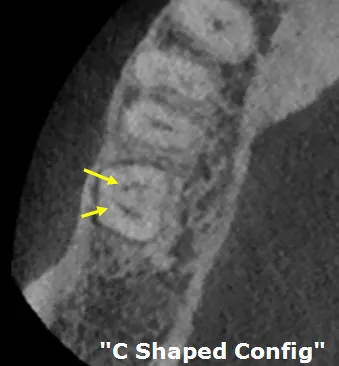 CBCT coronal slice revealing classic C-shaped canal configuration in mandibular second molar
