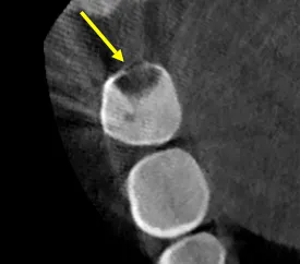 CBCT showing extent of distal caries