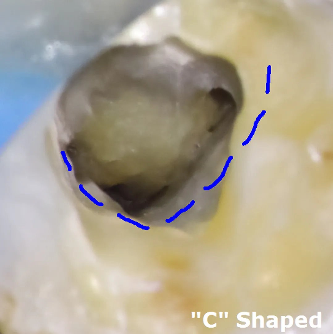 Clinical photo showing modified trapezoidal access cavity design for C-shaped canal system