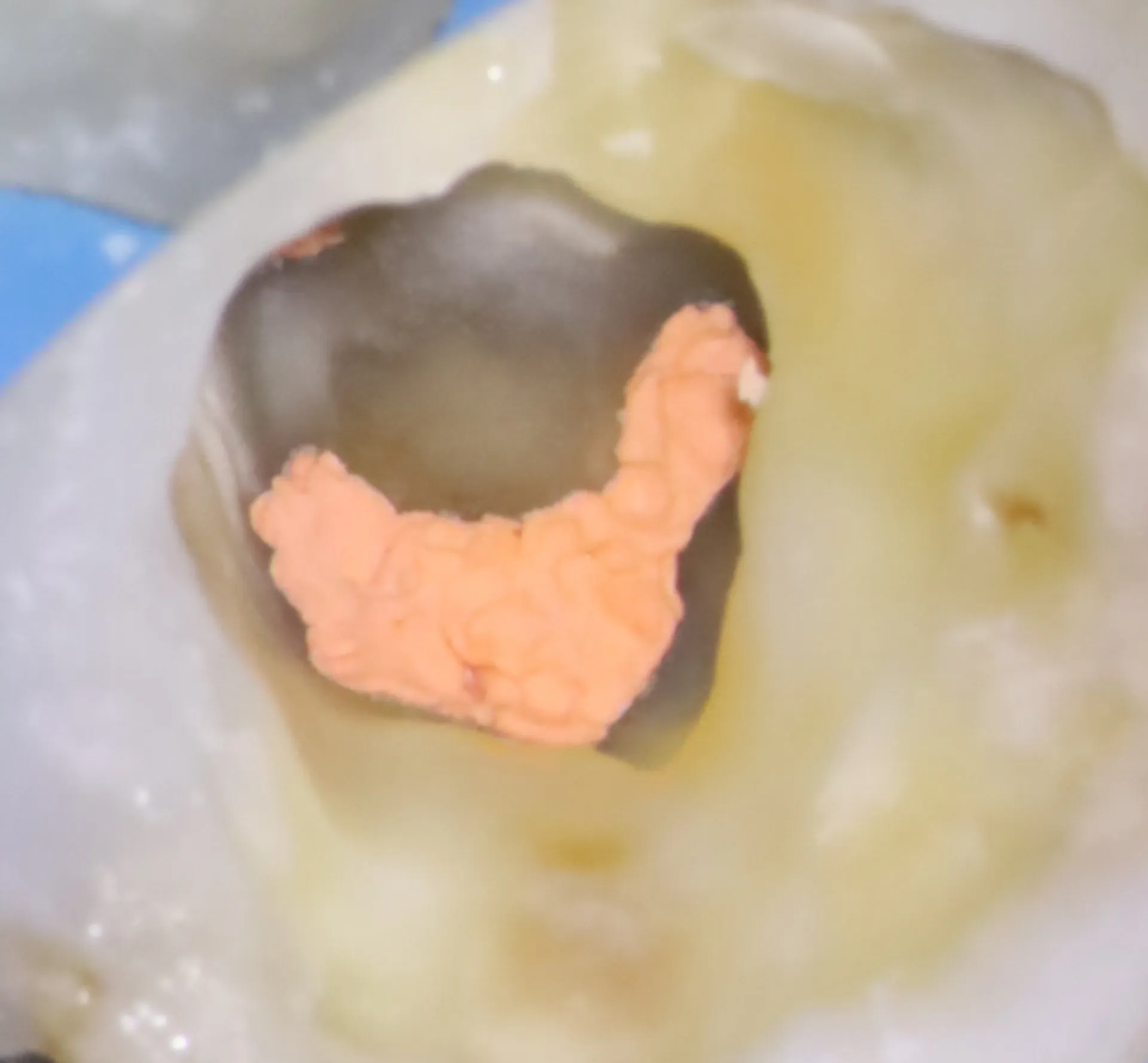 Final radiograph demonstrating complete three-dimensional obturation of C-shaped canal anatomy