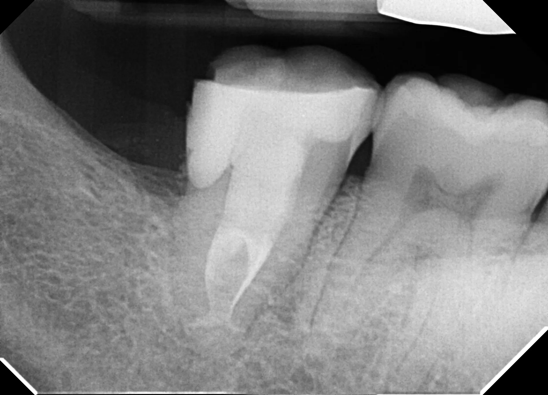 Final radiograph of anatomy and caries address