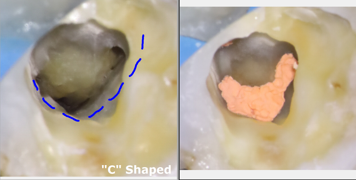 C-Shaped Canal Configuration w/ Distal Caries