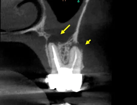 Pre-operative CBCT radiograph showing maxillary first molar with missed MB2 canal and periapical radiolucency/bone loss