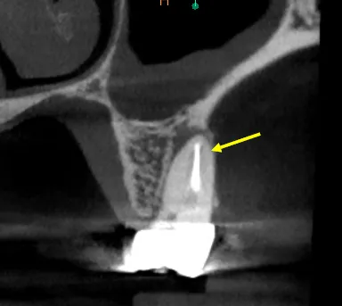 CBCT  slice revealing hidden MB2 canal location in maxillary molar