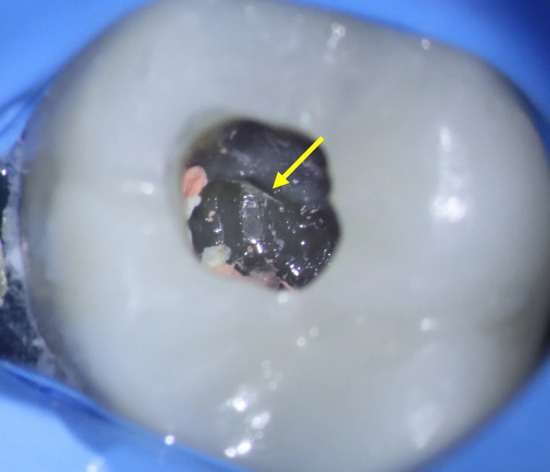 Clinical photo showing hidden canal with contaminated root canal seal