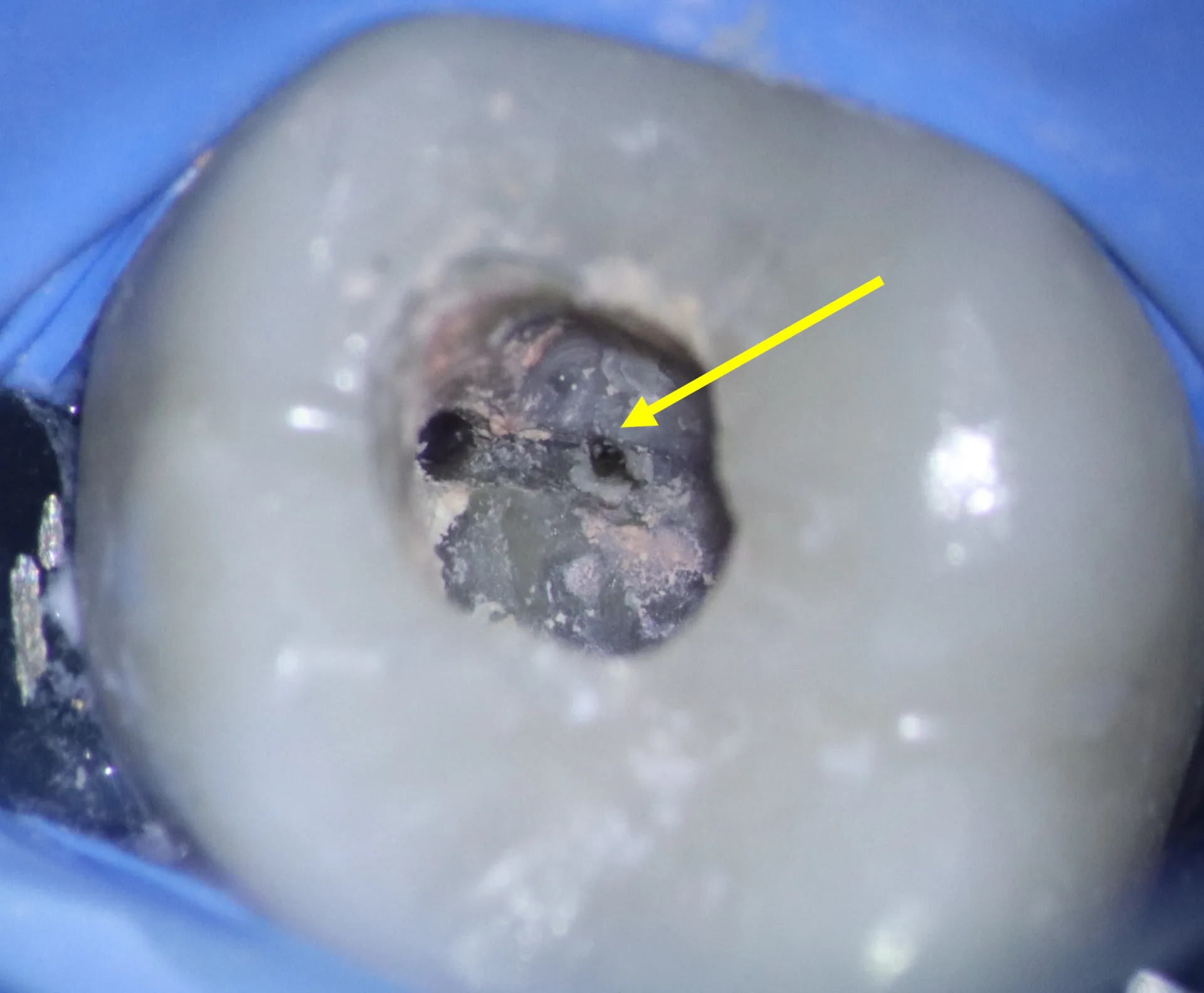 Intraoperative photo showing successfully located MB2 canal orifice after calcified tissue removal