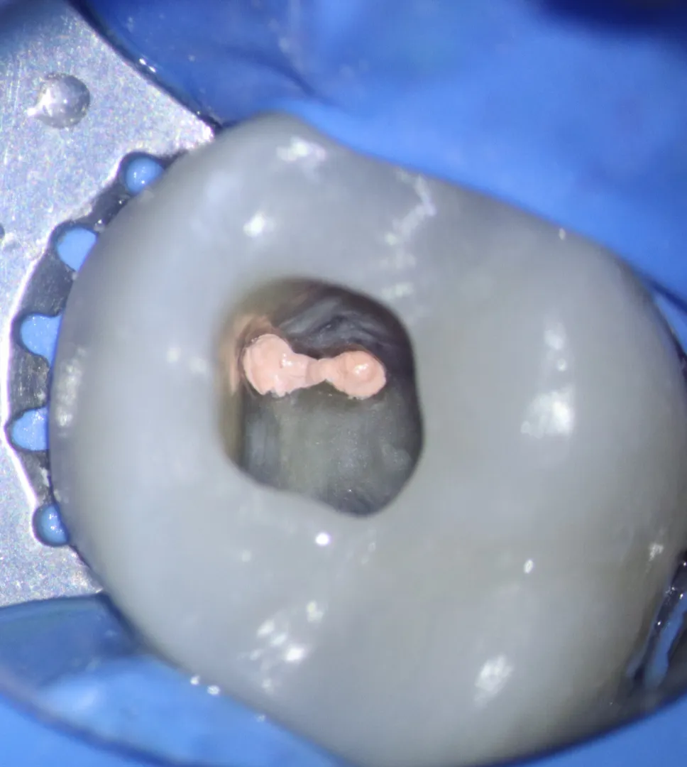 Fully cleaned and obturated MB1/2 canals