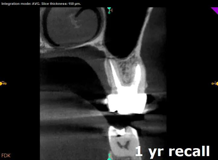 recall CBCT shows complete healing and bone regeneration 1