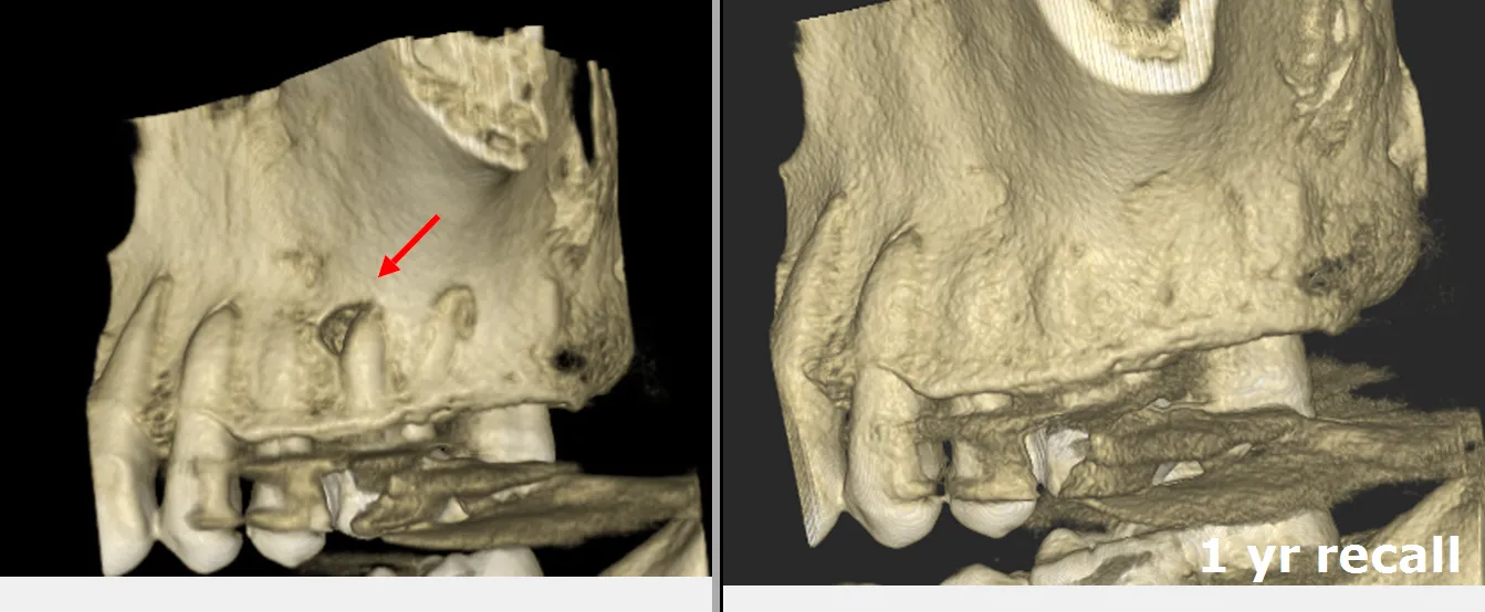 recall CBCT shows complete healing and bone regeneration