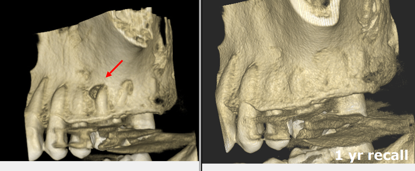 Severely Calcified MB2 Canal in Maxillary Molar