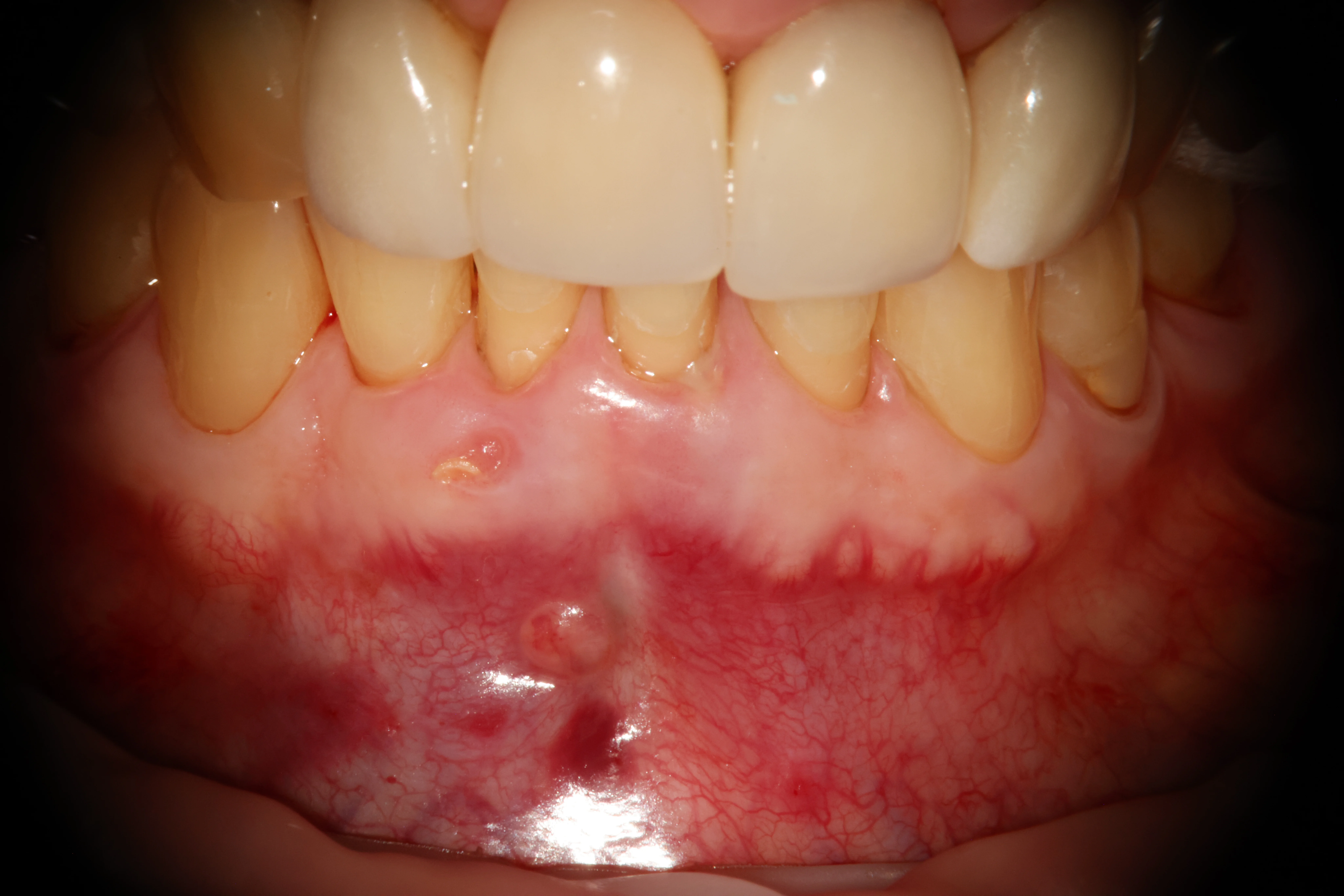 Pre-operative clinical photo showing buccal sinus tract near lower anterior teeth with visible swelling