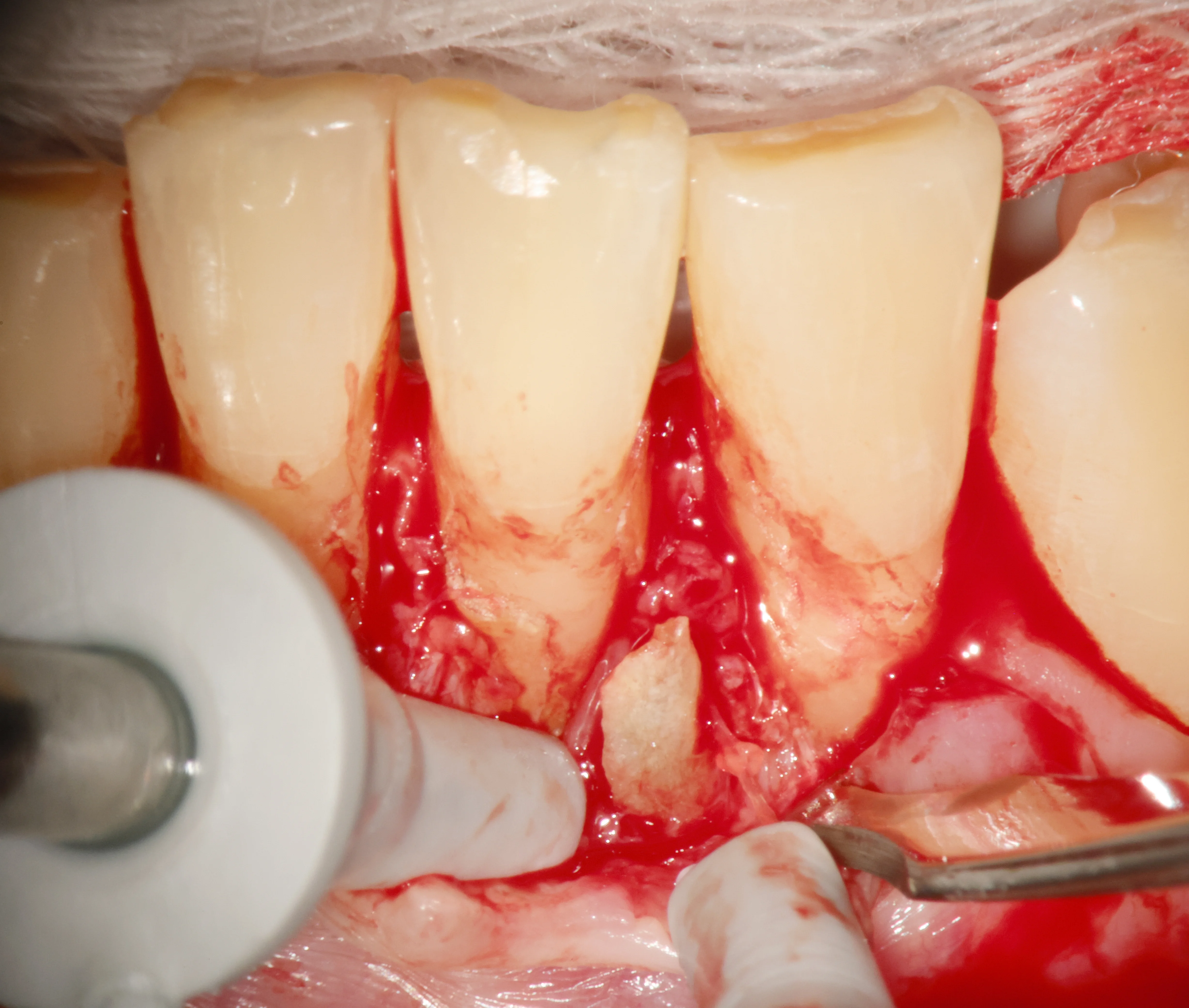 Intraoperative microscope view showing loose cementum fragment on root surface during surgical exploration