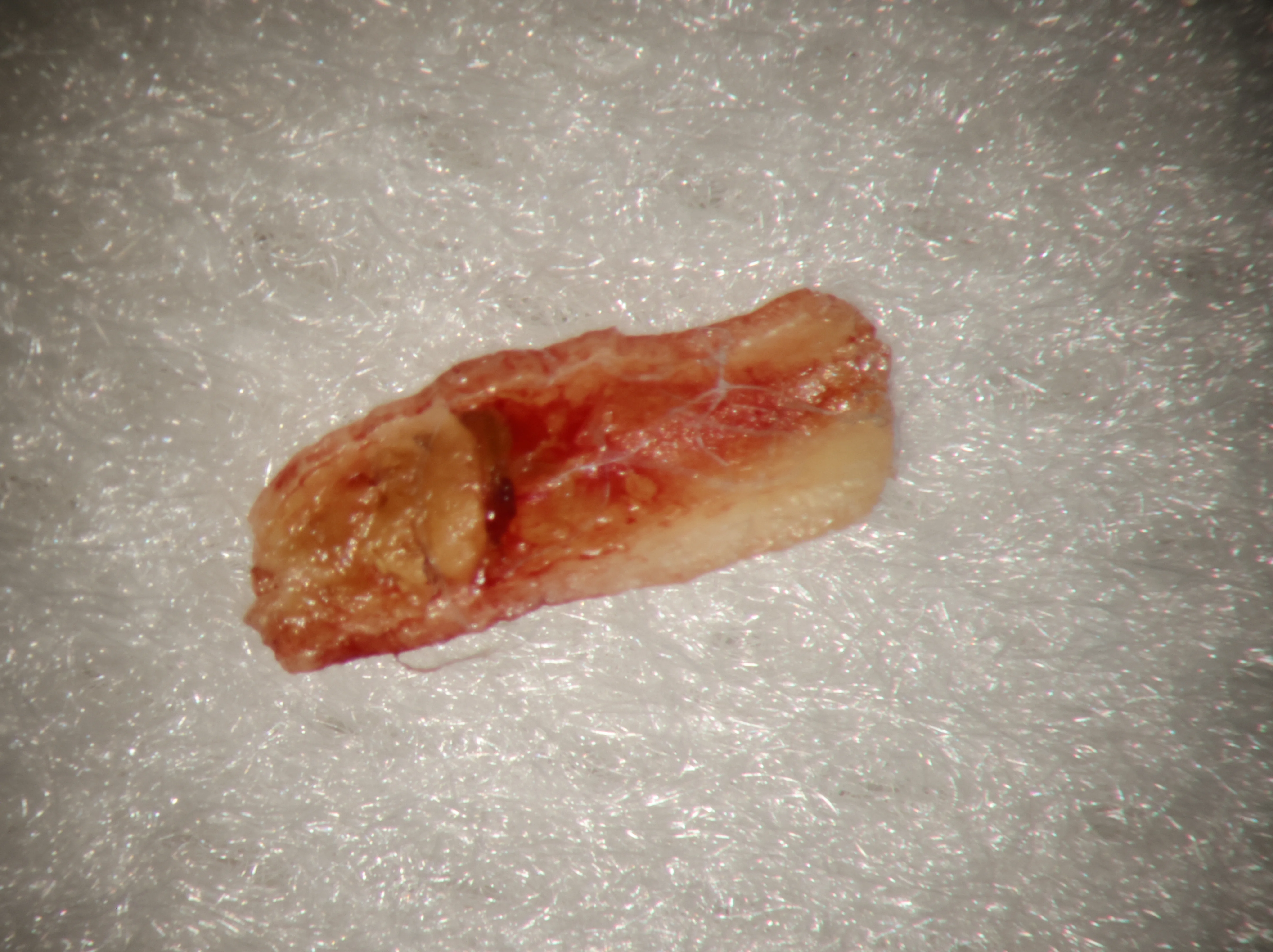 High-magnification view of cemental tear defect on root surface of tooth #24