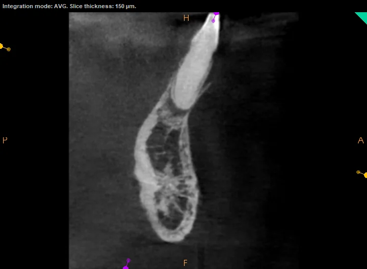 CBCT cross-section showing buccal bone plate and periapical radiolucency around lower anterior roots