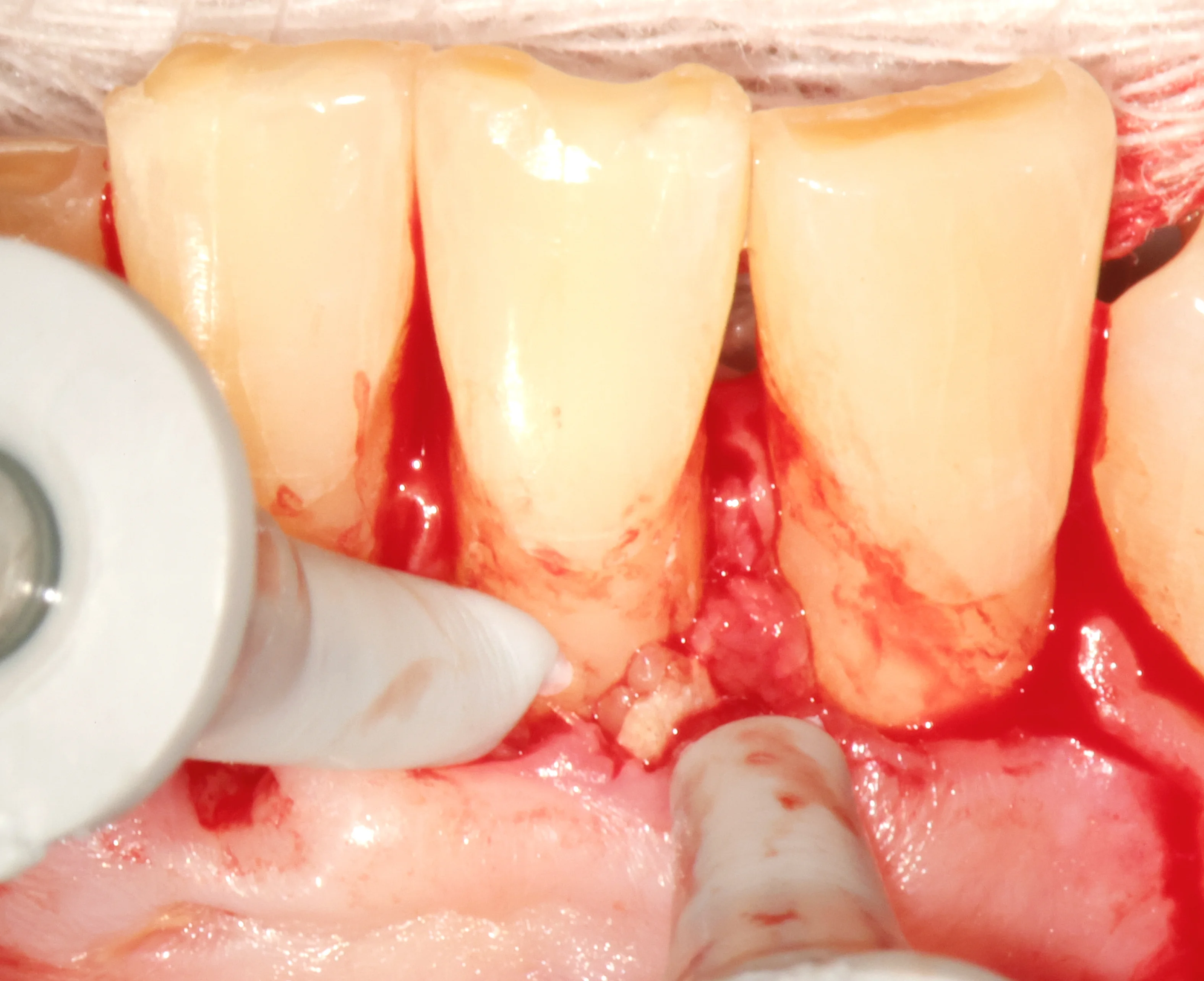 Microscope view of cemental tear site after debridement showing clean root surface