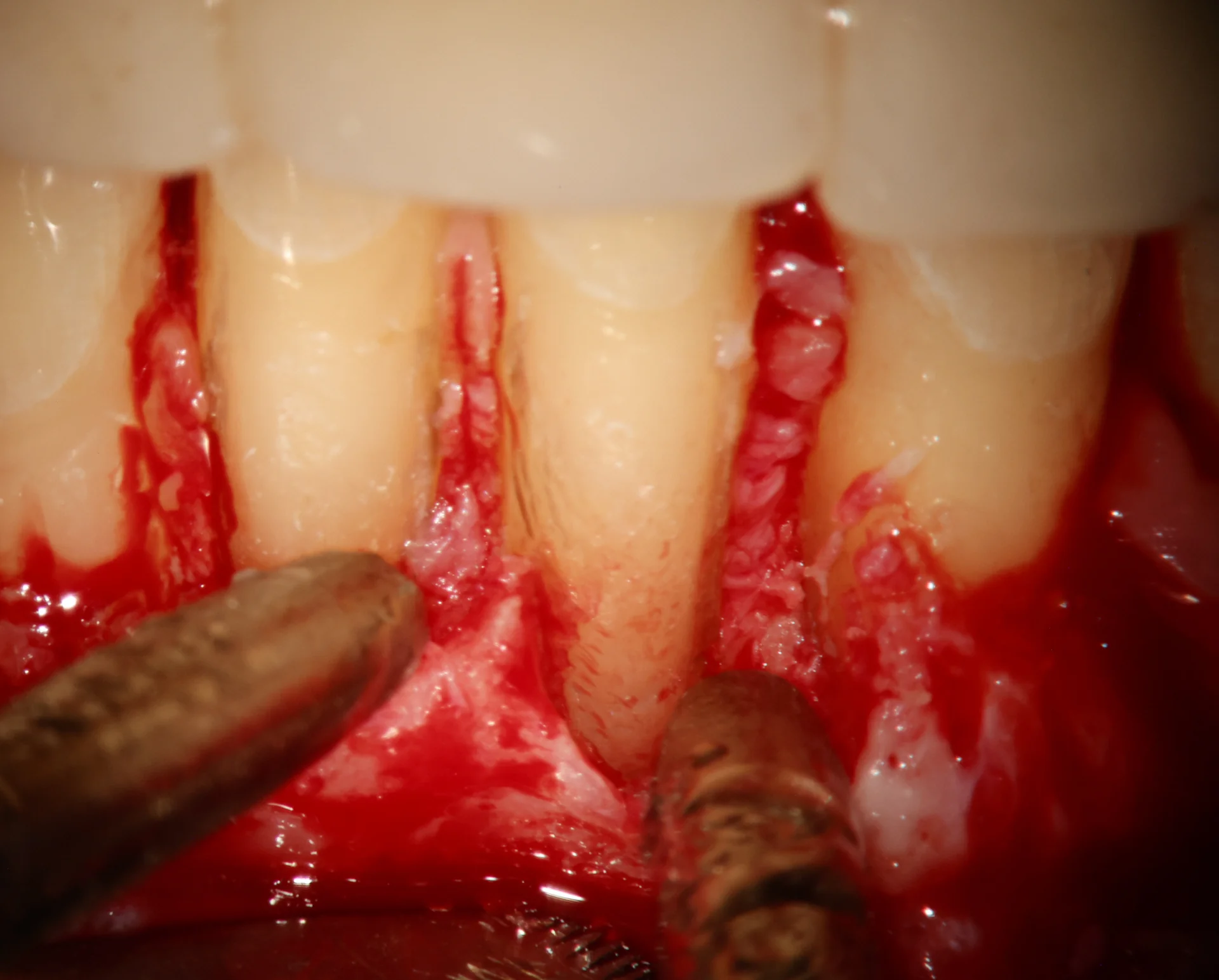 Post-surgical clinical photo showing sutured flap and repaired cemental tear site