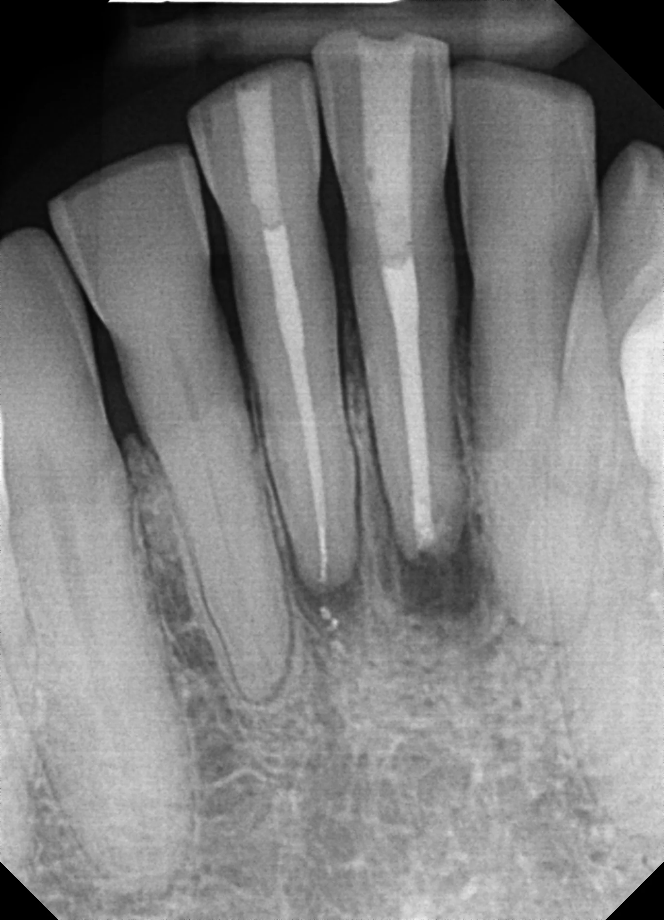 Post-operative radiograph showing root canal fill and healing at surgical site