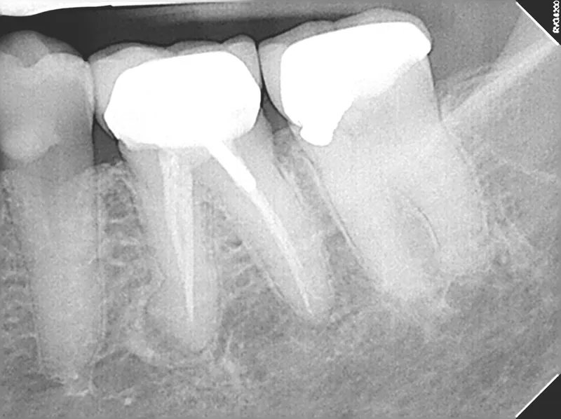 Pre-operative periapical of tooth #19 — prior root canal with persistent periapical pathology