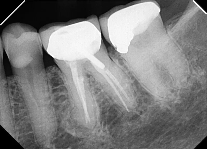 3.4-year recall radiograph — complete resolution of the periapical lesion, tooth in function