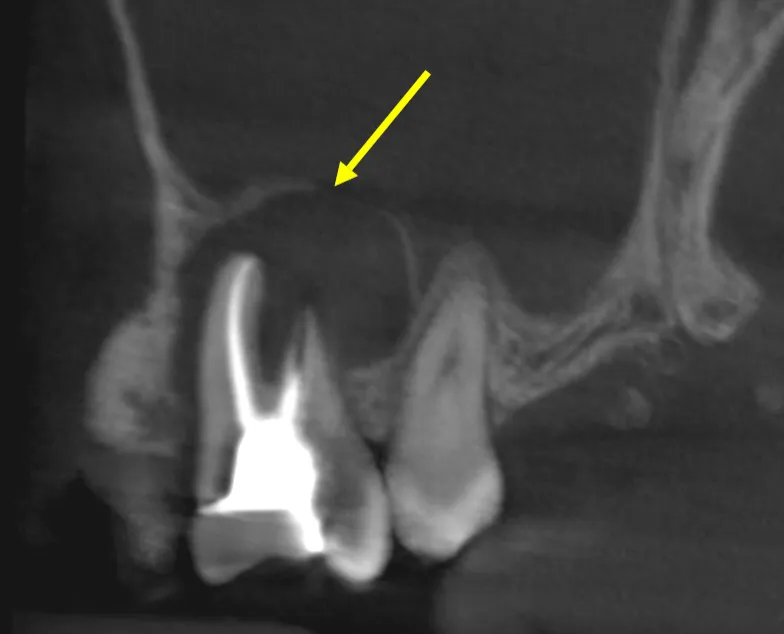 Pre-operative CBCT showing periapical radiolucency into the maxillary sinus