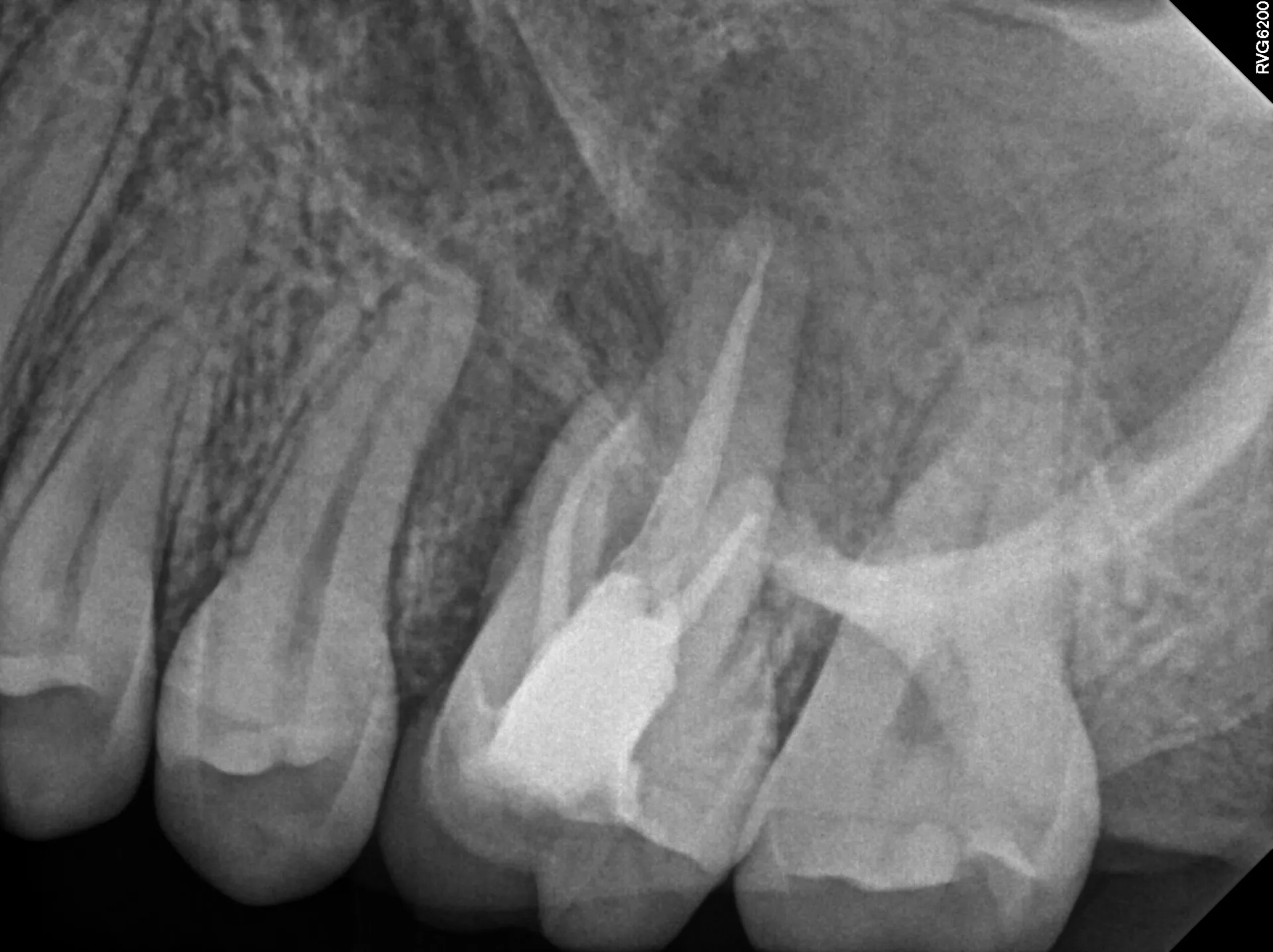 Pre-operative radiograph with sinus involvement