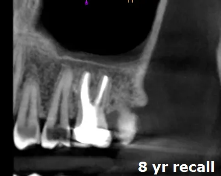 8 year follow-up radiograph showing significant bone regeneration around treated tooth