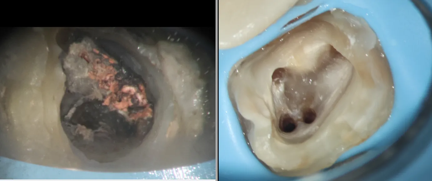 Endo-Perio Lesion — Combined Infection Treatment Case