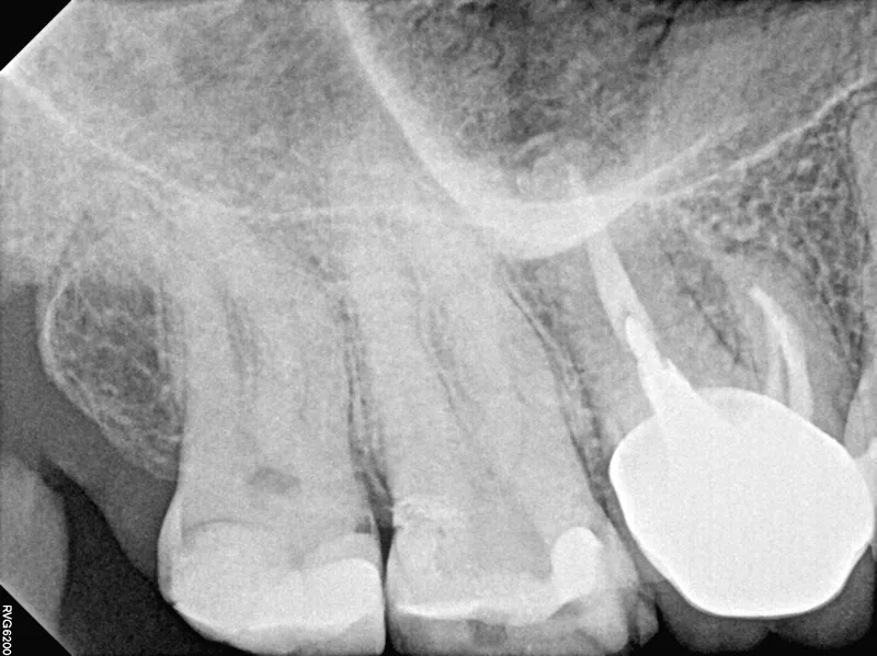 Pre-operative periapical of tooth #3 — prior root canal with persistent pathology and perforation defect