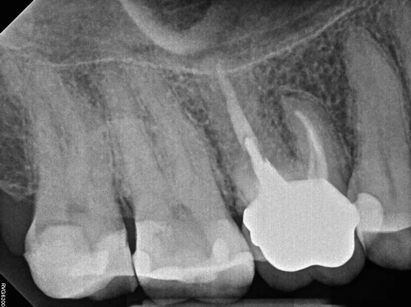 5-year recall radiograph — bone fill, no recurrent infection, tooth in function