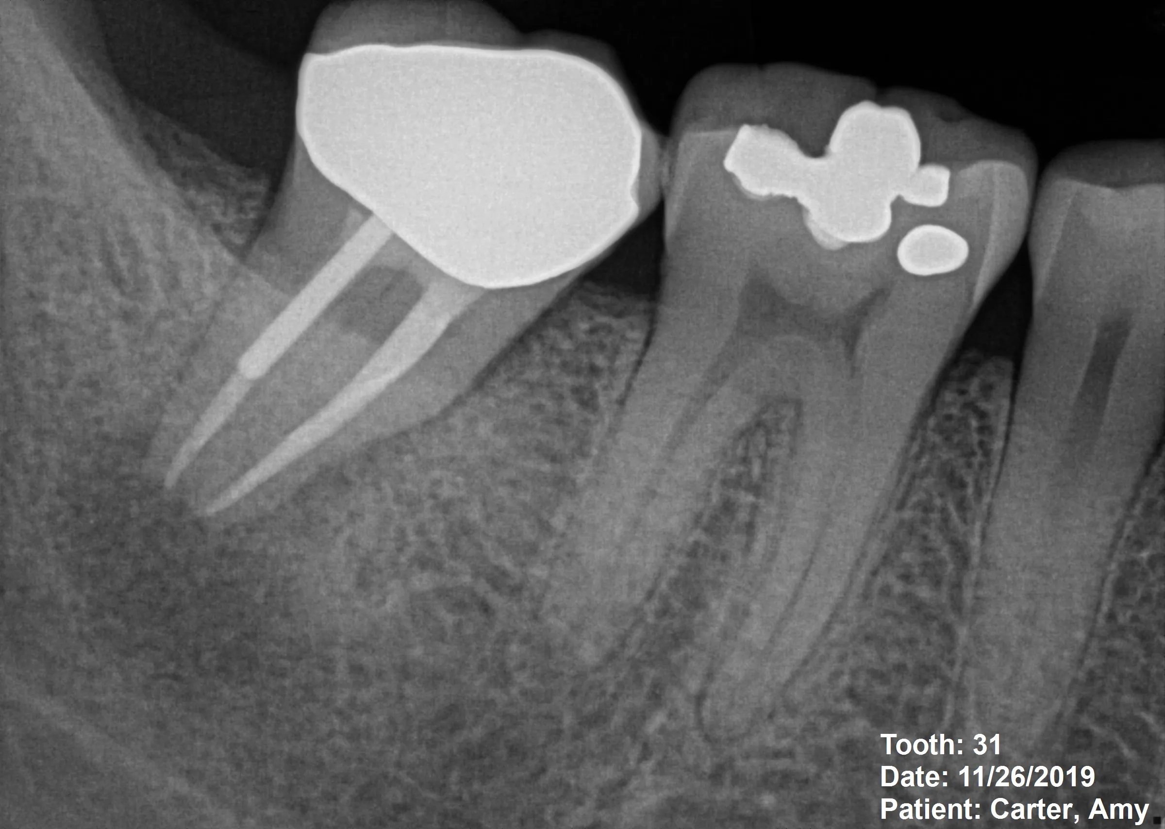 Pre-operative radiograph showing apical lesion and failed root canal with post