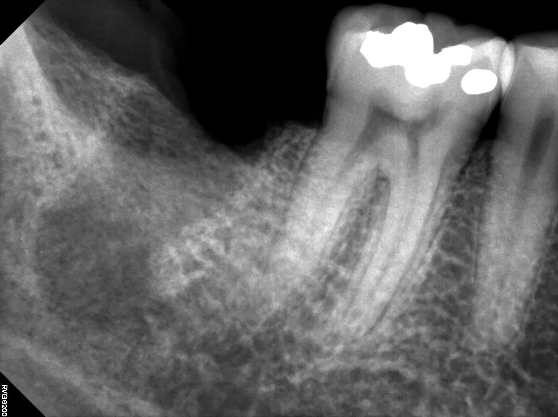 Radiograph showing extraction socket of molar