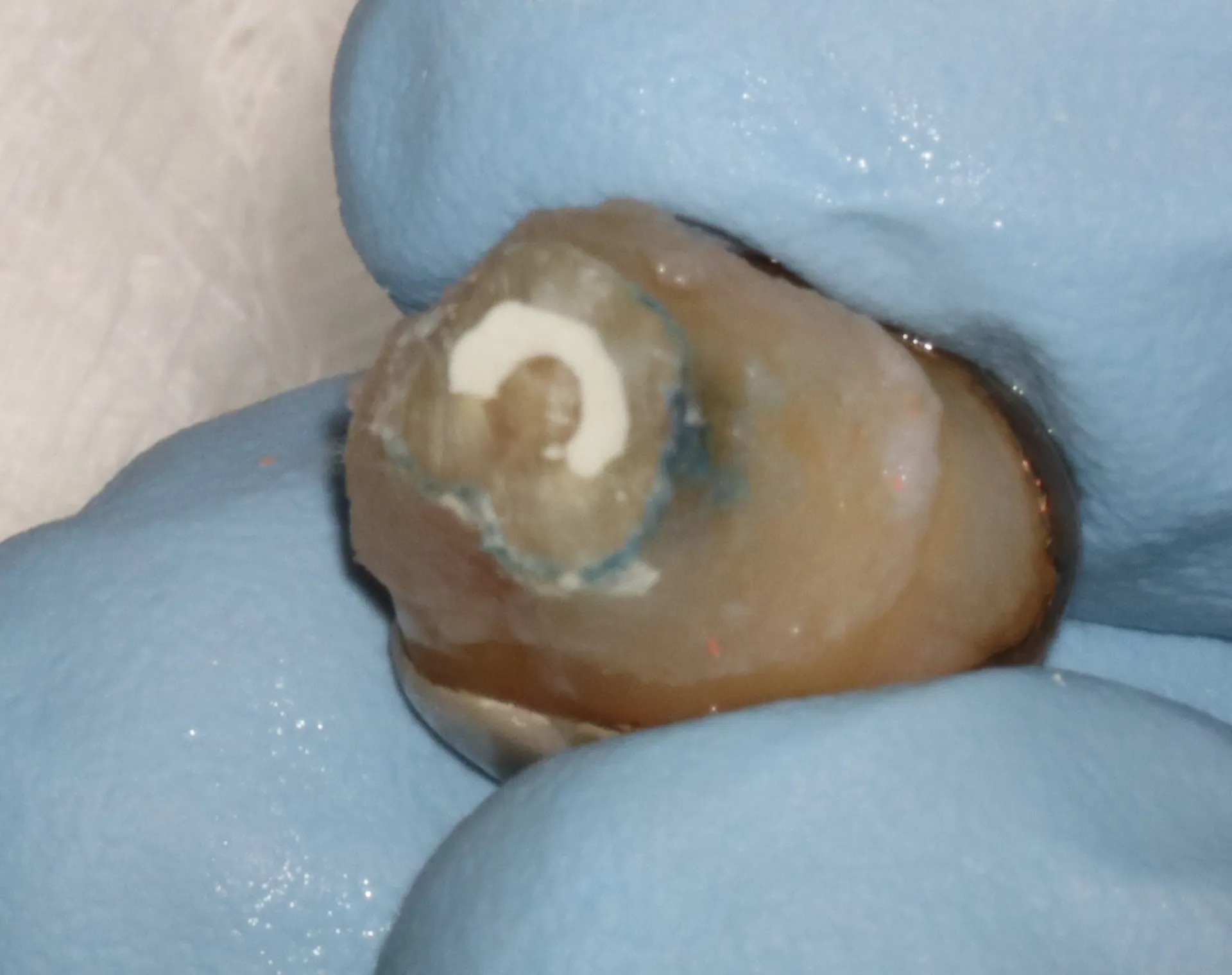 Post-sectioning, retrofill with MTA on extracted tooth
