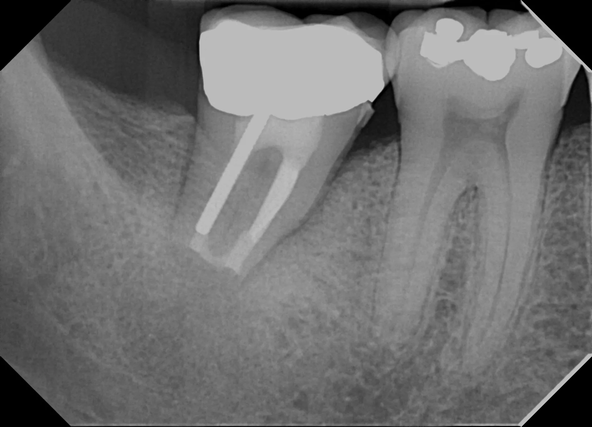 Radiograph immediately after reimplantation
