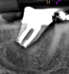 CBCT at 12-month recall showing bone regeneration and healing