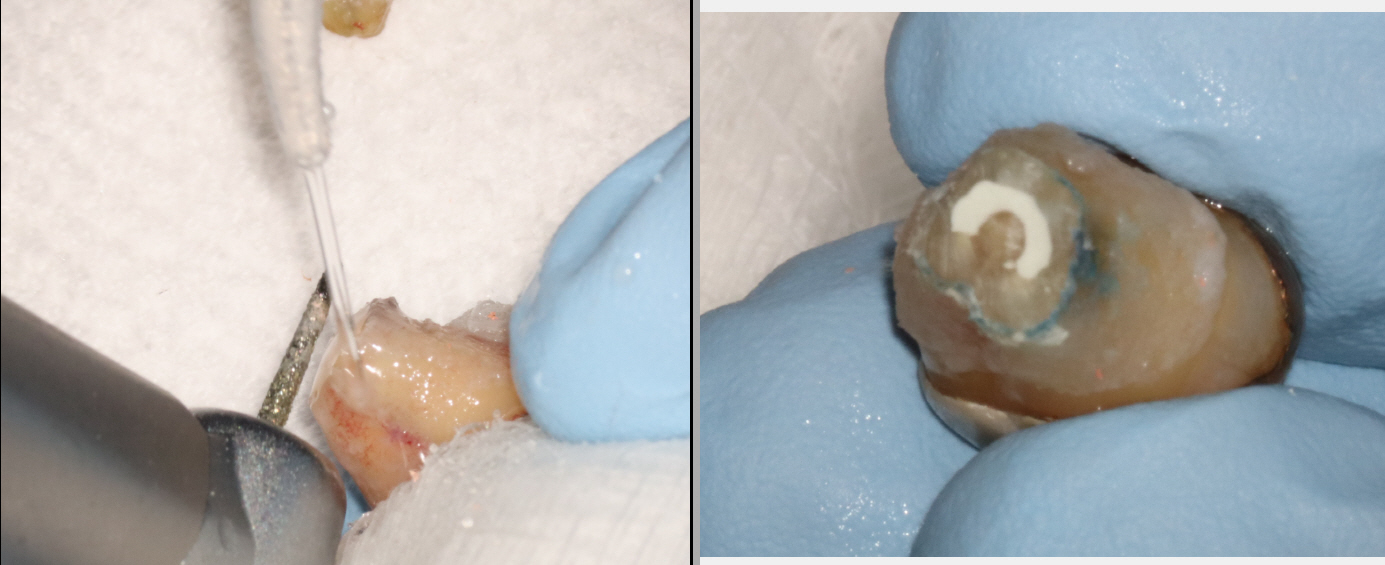 Extraction and Reimplant a Molar