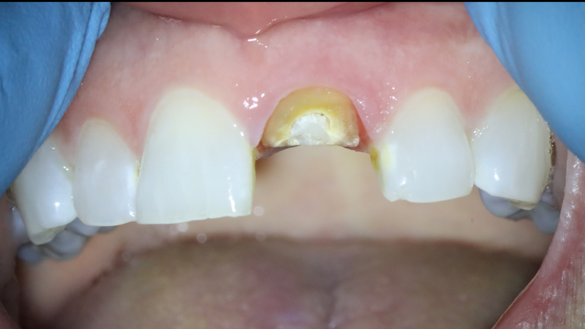 Saving a Fractured Central Incisor