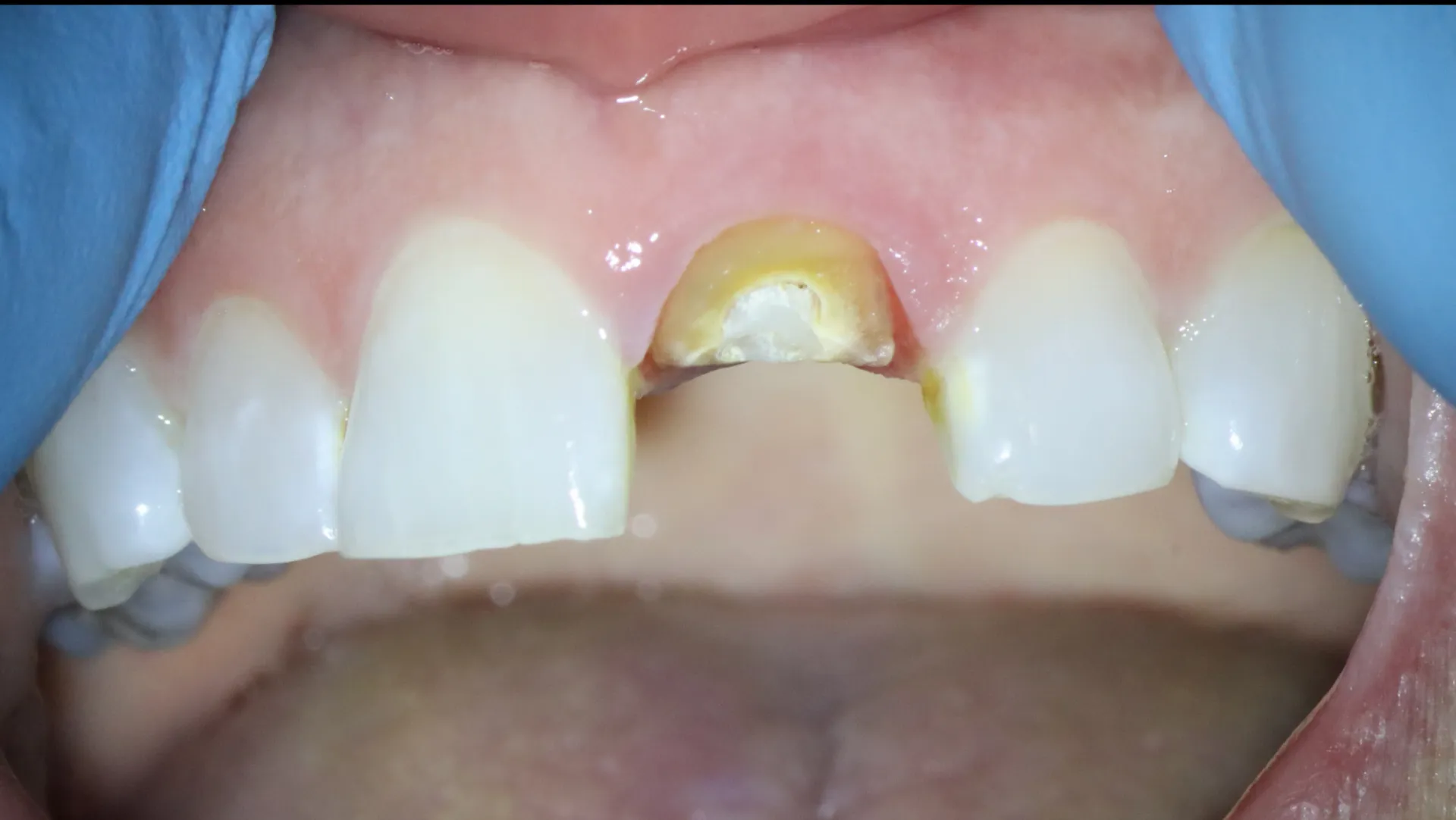 Fractured Front Tooth Saved — Retreatment Case