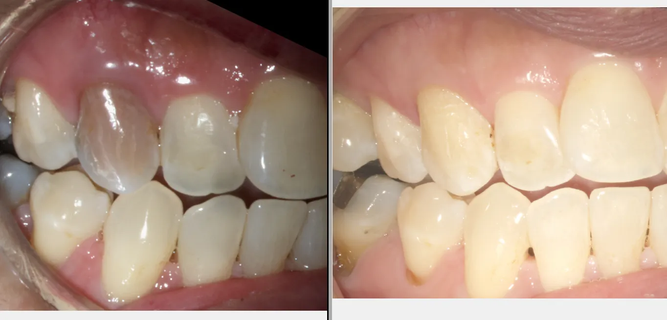 Long-Standing Adult Discoloration