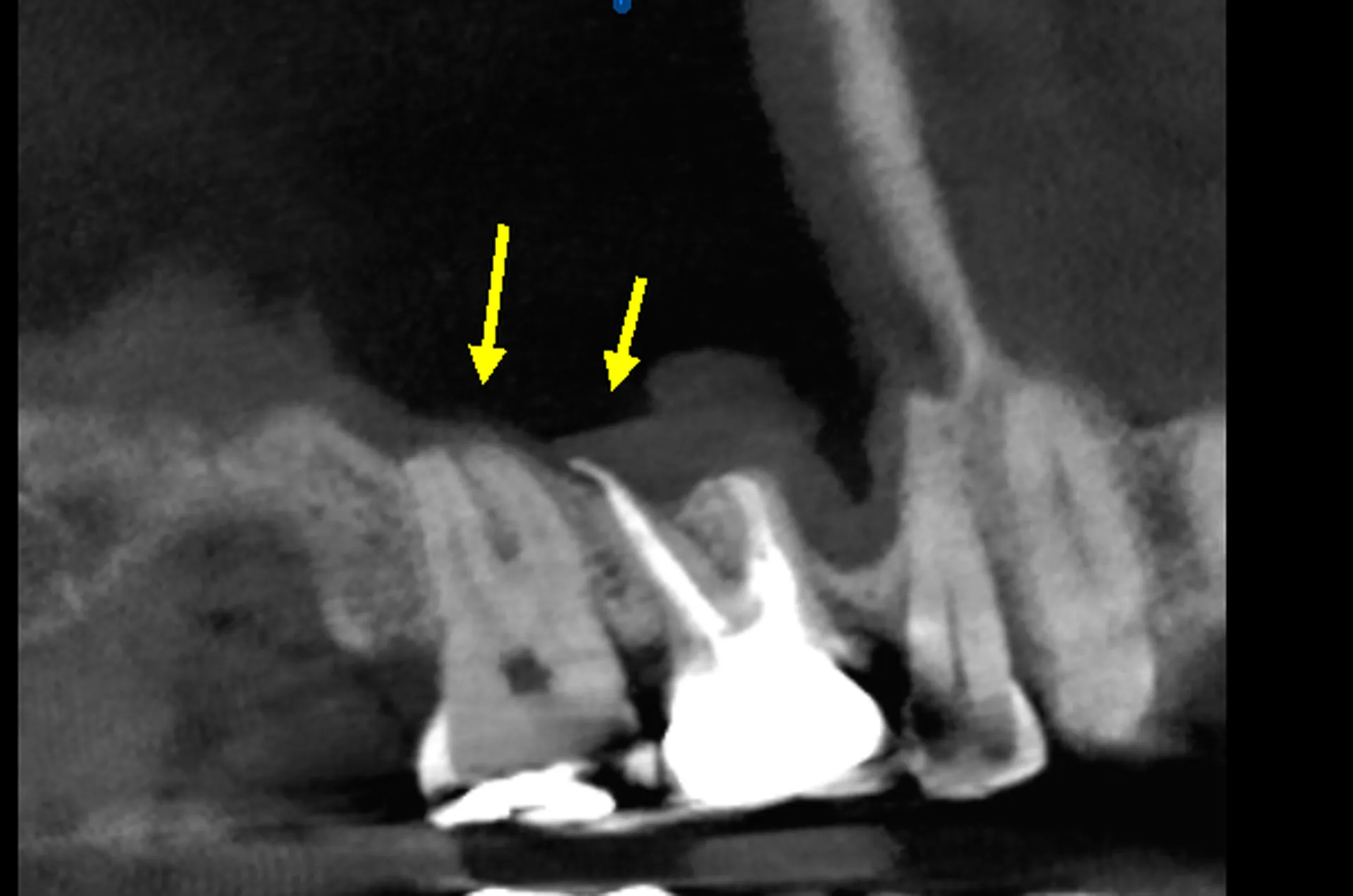 Maxillary Sinusitis Mimicking Root Canal Pain