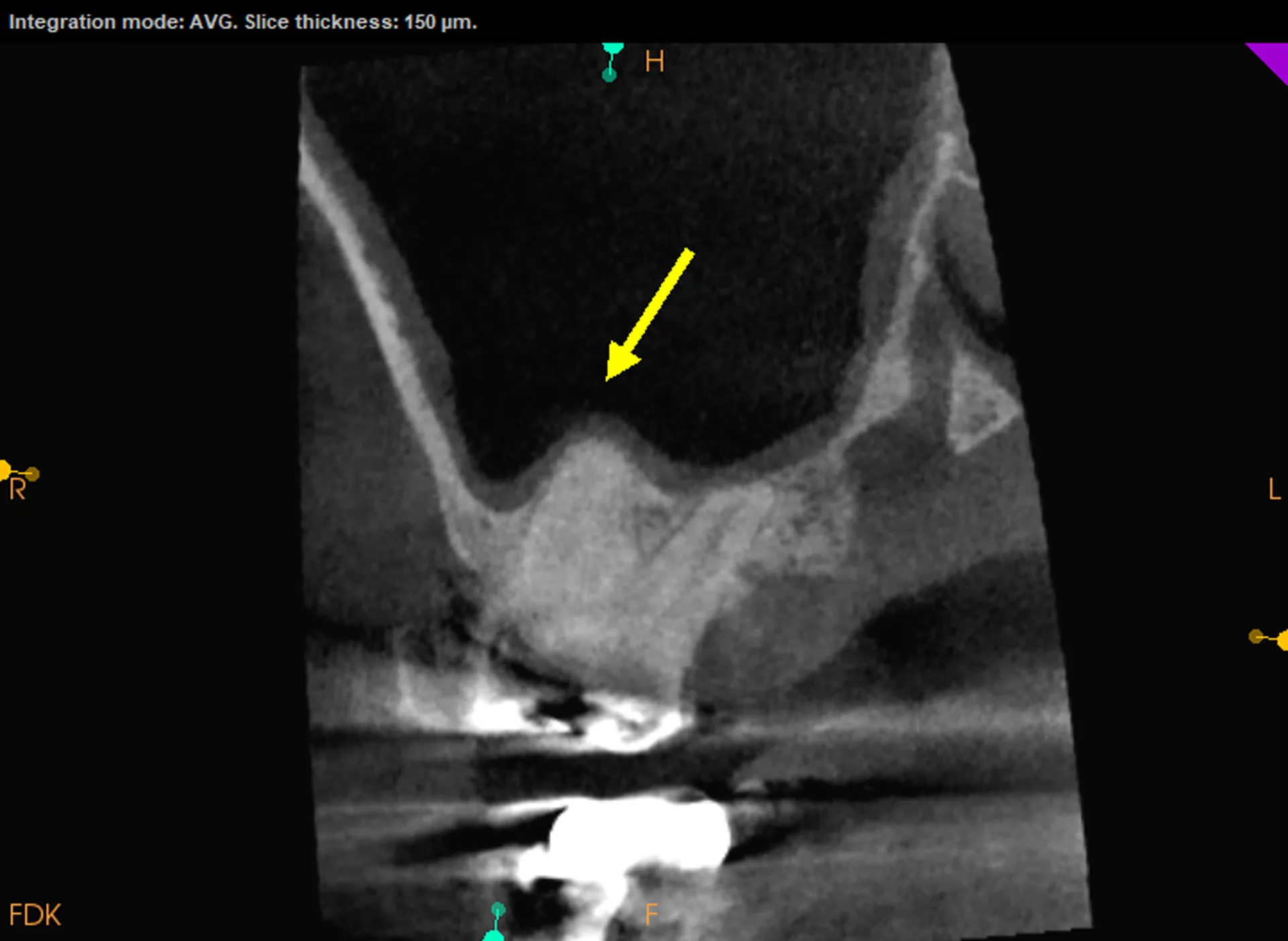 CBCT cross-section of tooth #2 showing MB root in close proximity to maxillary sinus membrane