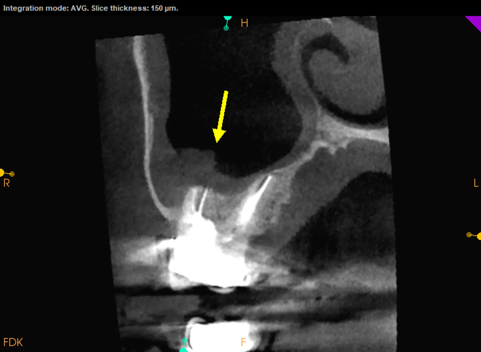 CBCT cross-section of tooth #3 showing MB root extending into maxillary sinus