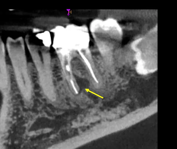 Pre-operative CBCT showing mandibular molar with furcation perforation and radiolucency at perforation site and apical lucency