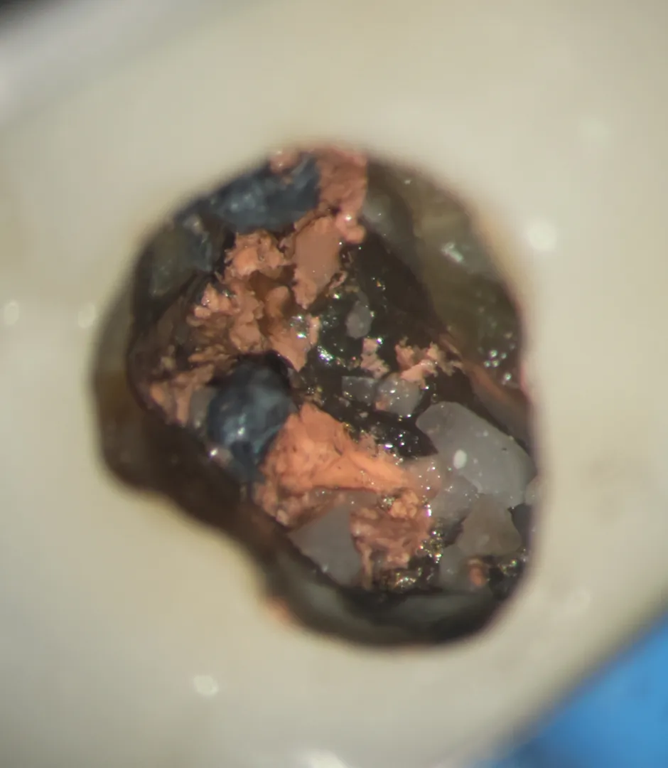 Clinical photo showing active contamination  in mandibular molar