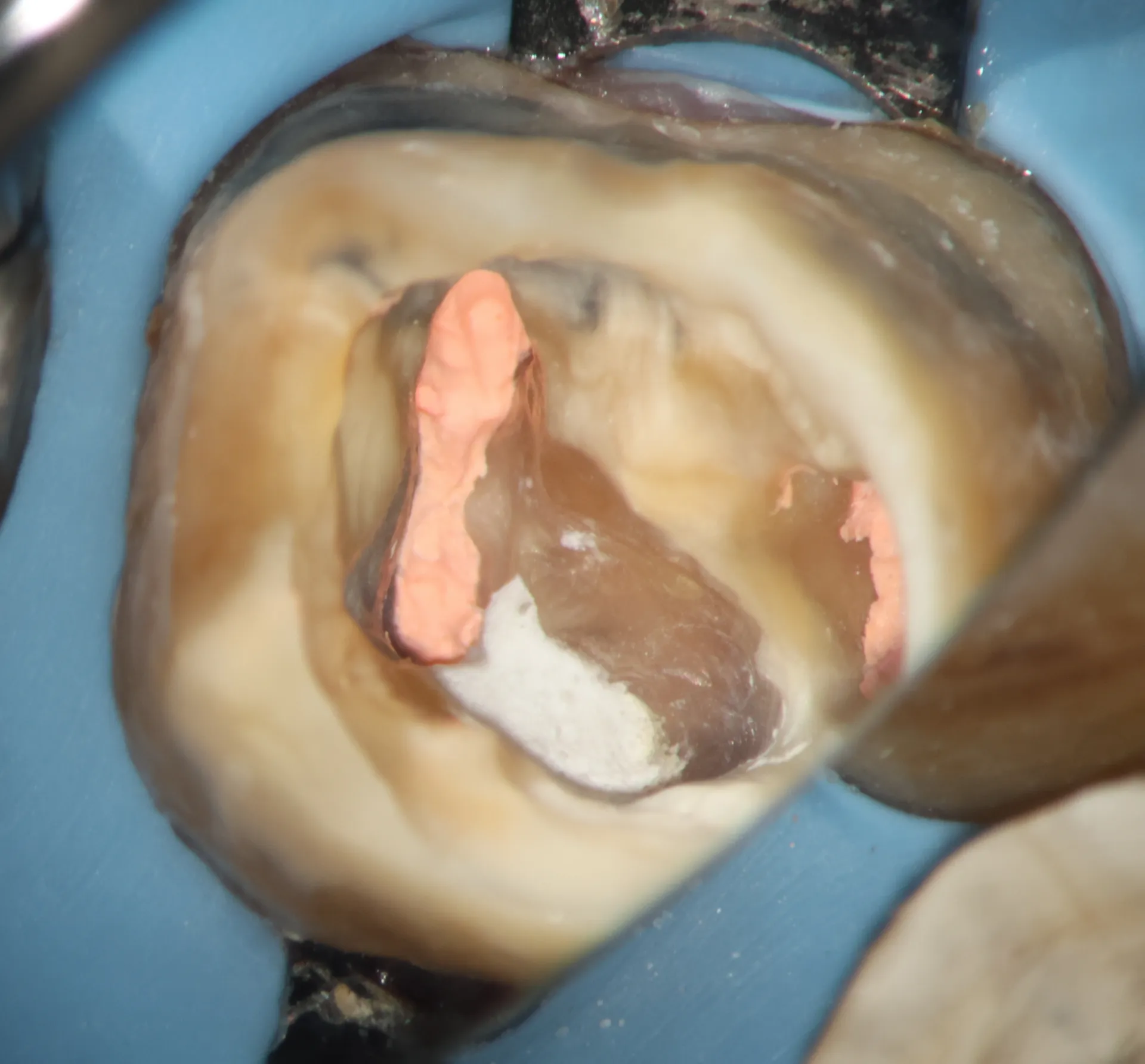 obturation and MTA repair