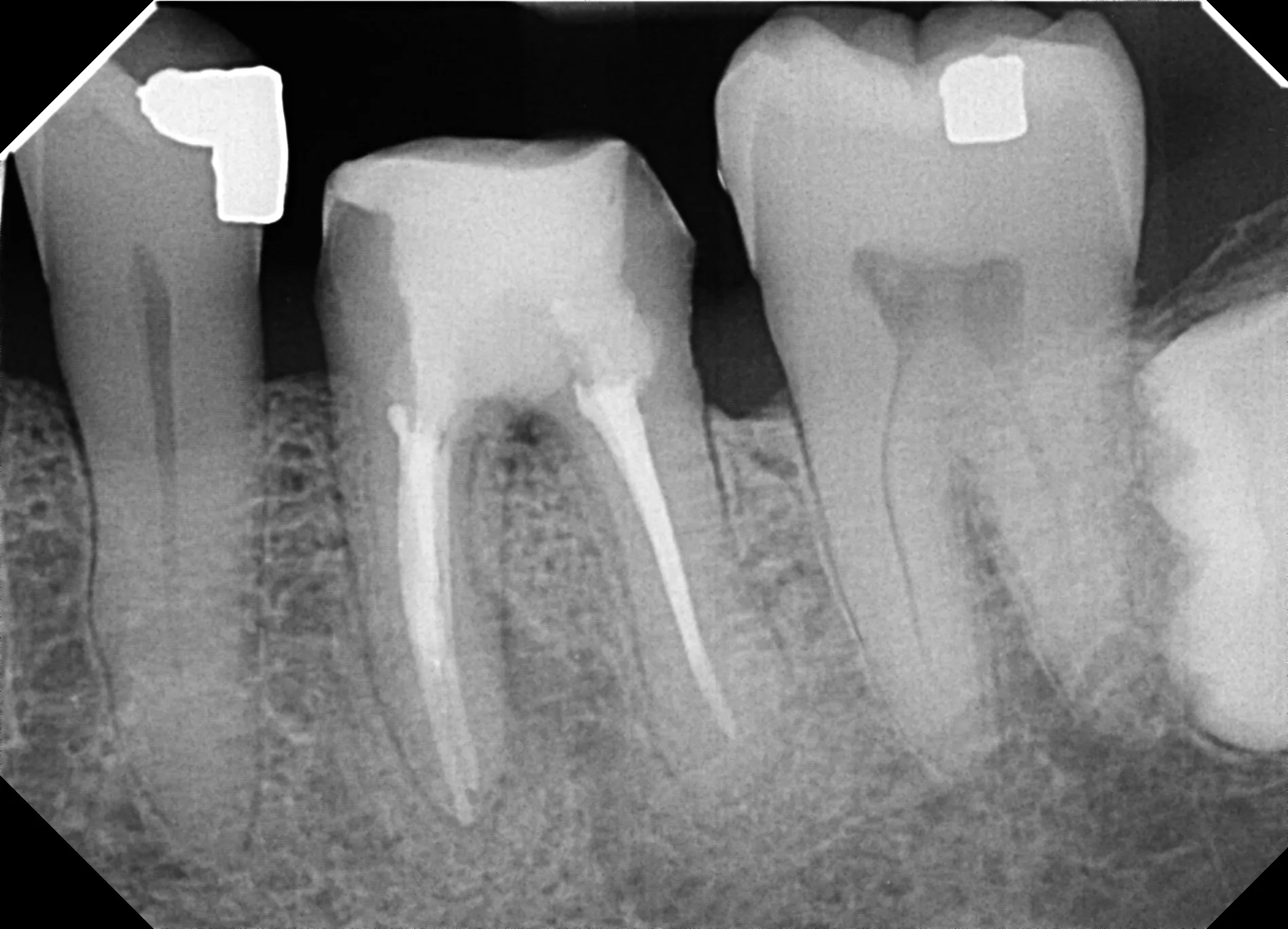 obturation and MTA repair