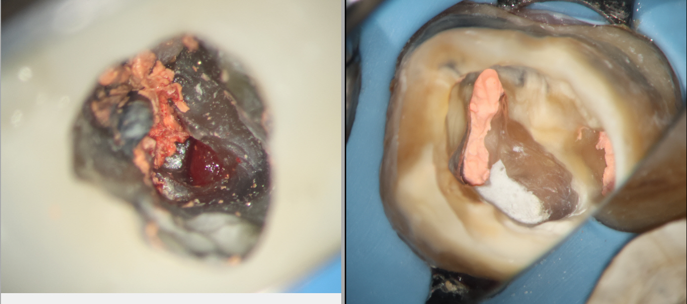 Furcation Perforation Repair in Mandibular Molar