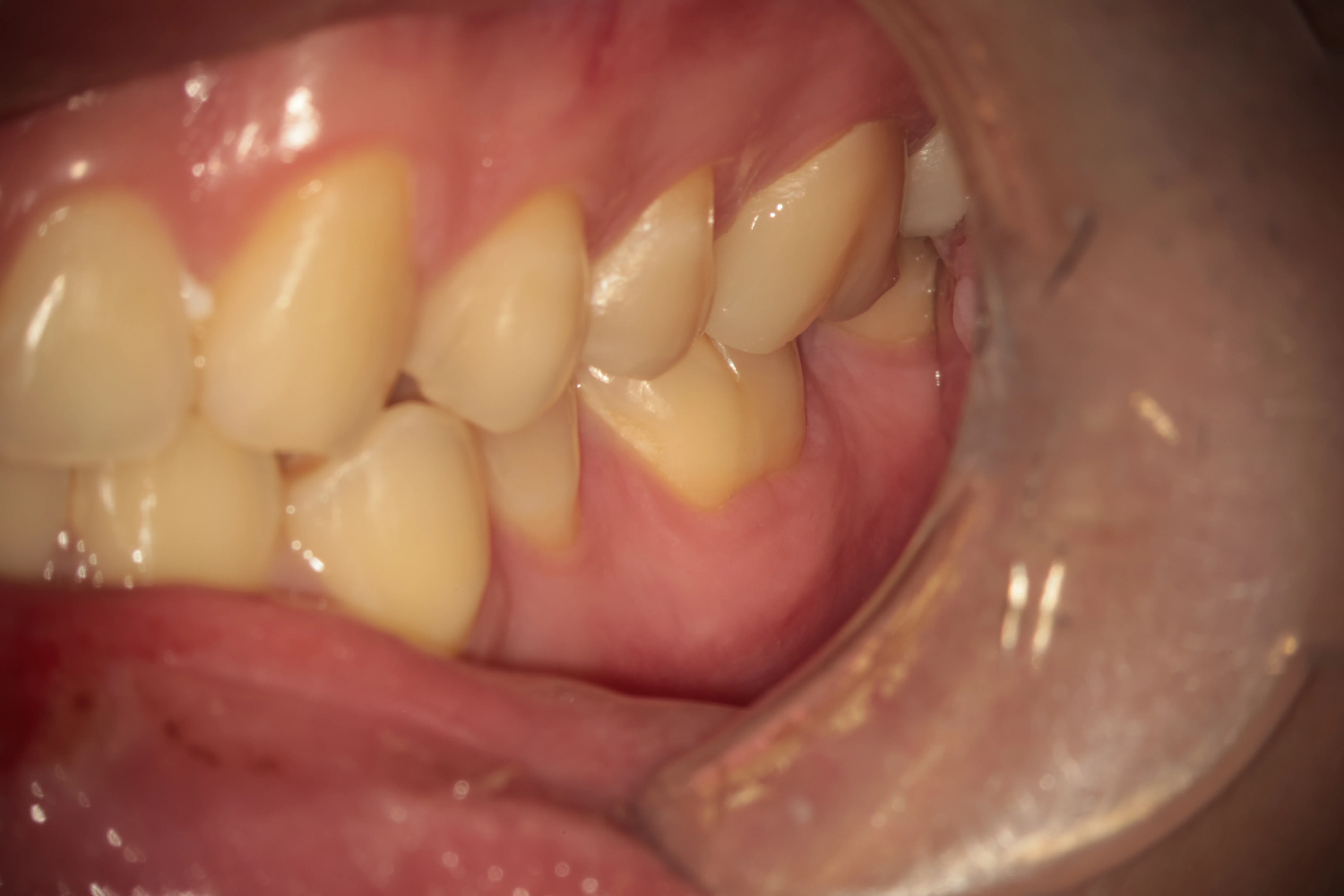 Pre-operative image for The Hidden Mb2 Dental Enigma What Two Specialists Overlooked case