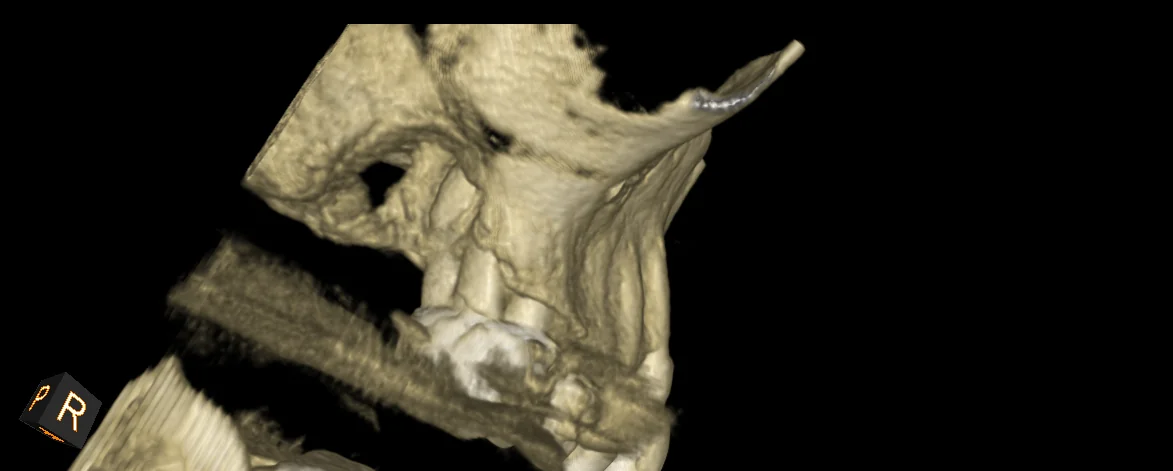 CBCT image of maxillary molar with irregular bone borders and cortical plate involvement