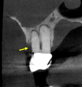 CBCT cross-section for throbbing tooth pain and eye case